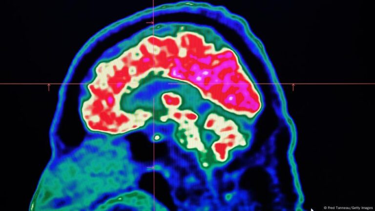 أمل جديد لسرطان الدماغ ـ علاج ثلاثي يزيد فرص النجاة – DW – 2025/6/11