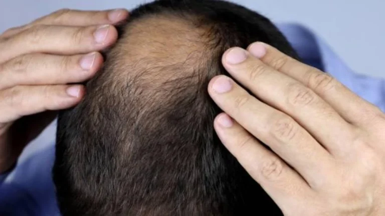 علاج جديد قد ينهي معاناة الصلع.. هل اقتربنا من نهاية تساقط الشعر؟ علاج جديد قد ينهي معاناة الصلع.. هل اقتربنا من نهاية تساقط الشعر؟