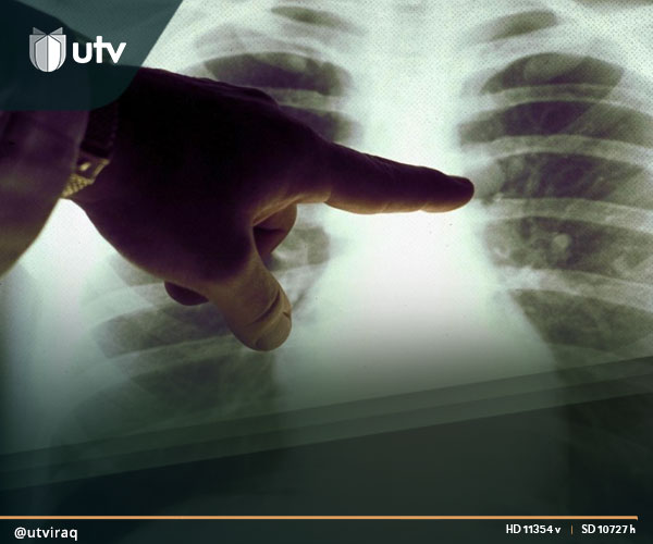 UTV العراق – ما هي العلاقة بين استهلاك أطعمة شائعة وسرطان الرئة؟ UTV العراق - ما هي العلاقة بين استهلاك أطعمة شائعة وسرطان الرئة؟