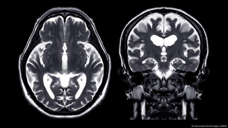 ما هو الارتجاج الدماغي وكيف نعالجه؟ – DW – 2025/7/25