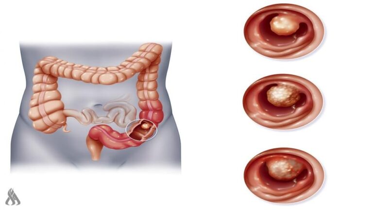 نقلة نوعية في تشخيص سرطان القولون باختبار دم بدقة 95% » وكالة الانباء العراقية (واع) نقلة نوعية في تشخيص سرطان القولون باختبار دم بدقة 95%
