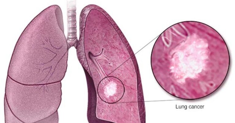 دراسة: المُحليات الصناعية تُضعف الاستجابة لعلاج سرطان الرئة "الفركتوز غذاء للسرطان".. كيف يساهم السكر في نمو الأورام؟