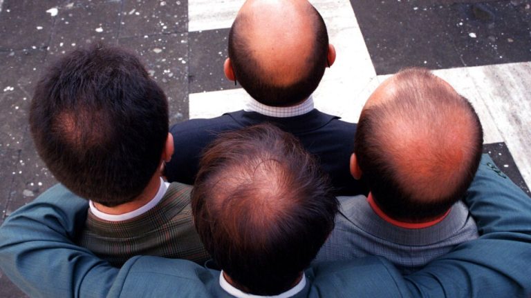 اكتشاف رابط قوي بين دواء مشهور يوصف لعلاج تساقط الشعر والميول الانتحارية لدى الرجال