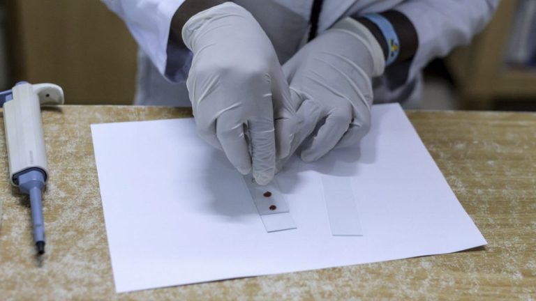 دراسة تكشف أن فصيلة الدم تؤثر في خطر السكتة الدماغية المبكرة