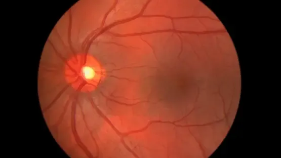 متغير جيني يسبب ضمور العصب البصري الوراثي متغير جيني يسبب ضمور العصب البصري الوراثي