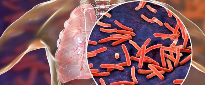 1.23 مليون ضحية للسل خلال 2024 1.23 مليون ضحية للسل خلال 2024