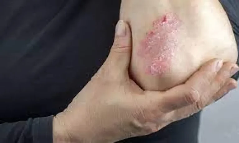 دواء يسرّع التئام جروح مرضى السكري دواء يسرّع التئام جروح مرضى السكري