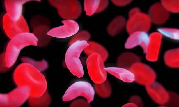 دواء يعالج فقر الدم المنجلي دواء يعالج فقر الدم المنجلي