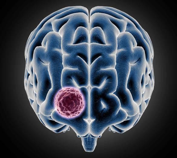 لا تتجاهلها.. أعراض تشير للإصابة بسرطان الدماغ لا تتجاهلها.. أعراض تشير للإصابة بسرطان الدماغ
