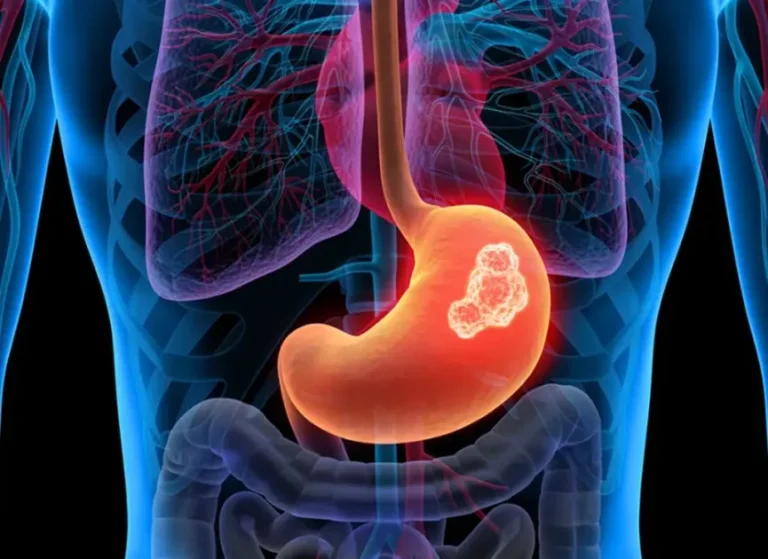 إنجاز يحل معضلة طبية.. بروتين يمنع عودة سرطان المعدة