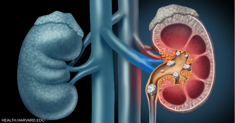 ثورة طبية.. الذكاء الاصطناعي يكشف سرطان الكلى في وقت قياسي