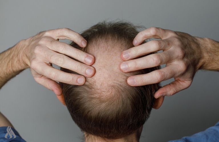 دواء جديد لمعالجة الصلع الوراثي لدى الرجال » وكالة الانباء العراقية (واع) دواء جديد لمعالجة الصلع الوراثي لدى الرجال