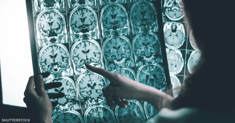 مرحلة ما قبل الأعراض.. دواء جديد يستهدف "شرارة" الزهايمر