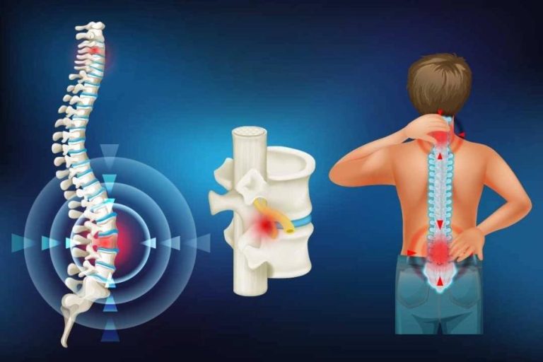 آلام الظهر وأسبابها (فيديو) | صحيفة الخليج