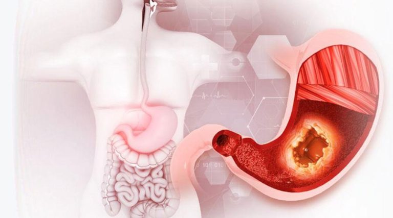 القرحة.. تآكل تدريجي لبطانة المعدة