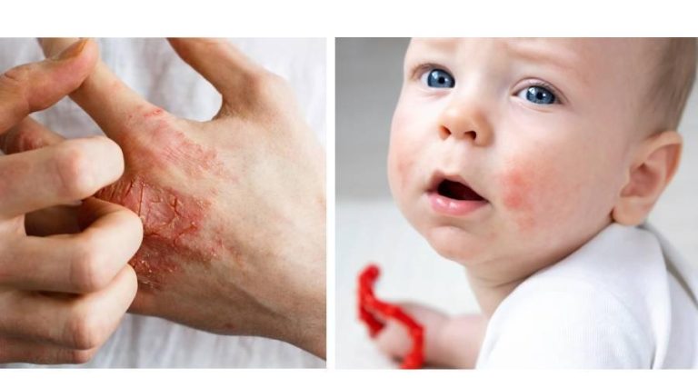 3 خطوات للتعامل مع أكزيما الشتاء