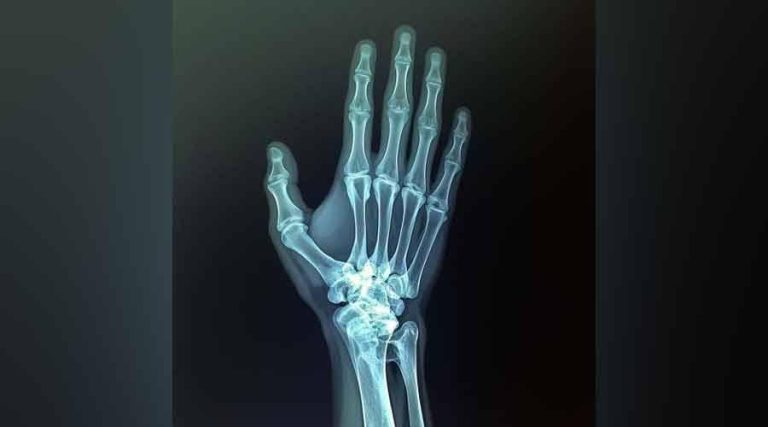 العلاج الهرموني «عبر الجلد» أكثر أماناً لعظام النساء