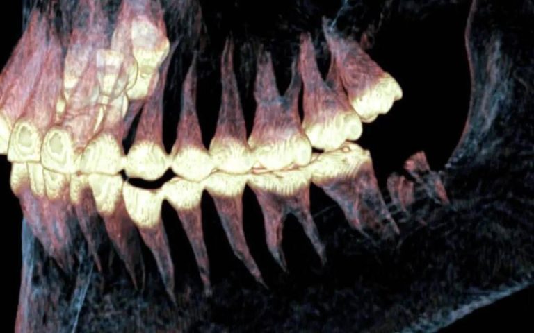 جراحة فك معقدة قبل 2500 عام جراحة فك معقدة قبل 2500 عام