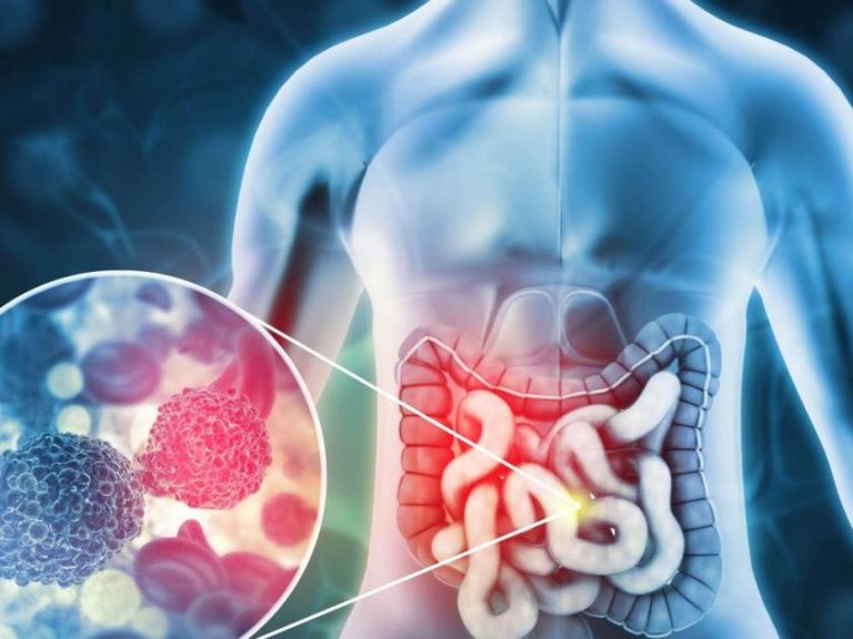 علماء يحذرون الشباب من سرطان القولون والمستقيم