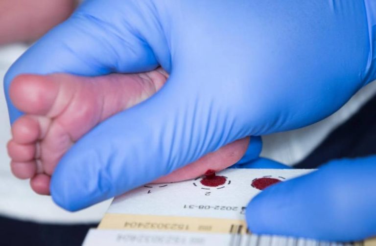 اسكتلندا تفحص المواليد للكشف عن «ضمور العضلات»